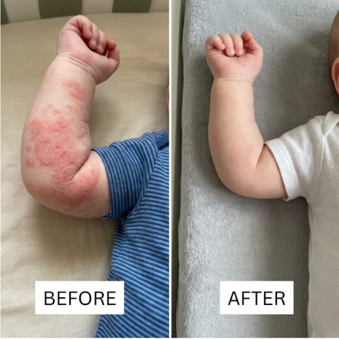 Honey Eczema - Baby Eczema cream
