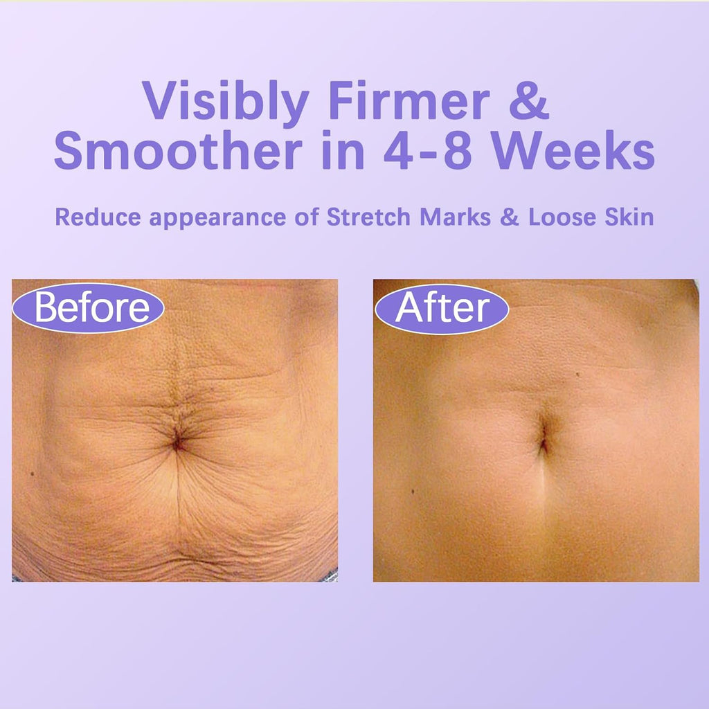 Tighten & Smooth Belly Cream – Firming Body Lotion for Stretch Marks & Sagging