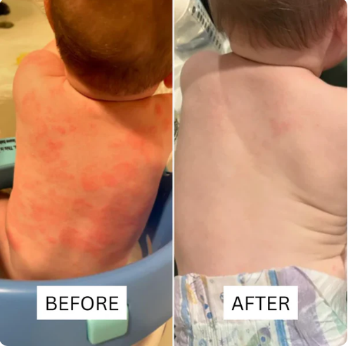 Honey Eczema - Baby Eczema cream